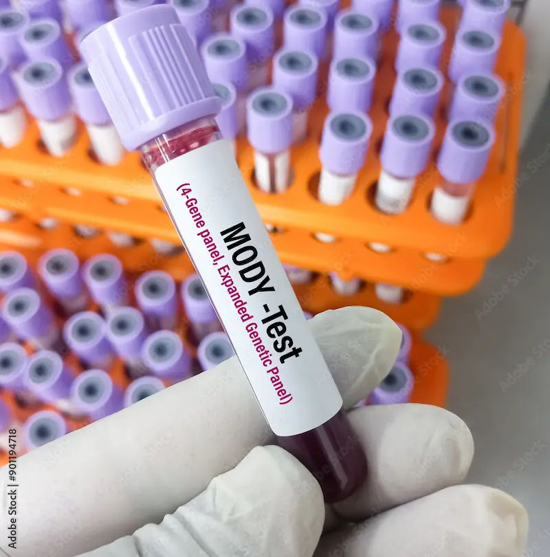 MODY Diabetes Overview and Treatment Options